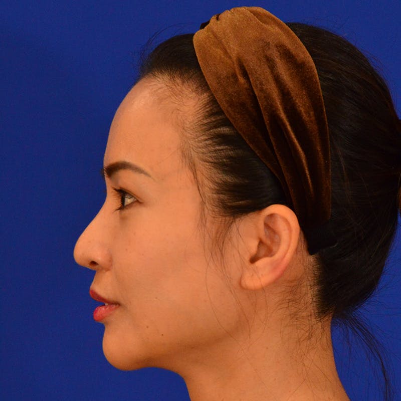 Revision Rhinoplasty Before & After Gallery - Patient 132405 - Image 9