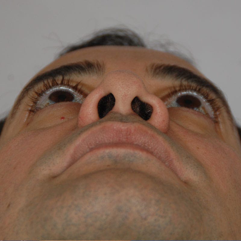 Revision Rhinoplasty Before & After Gallery - Patient 617931 - Image 7