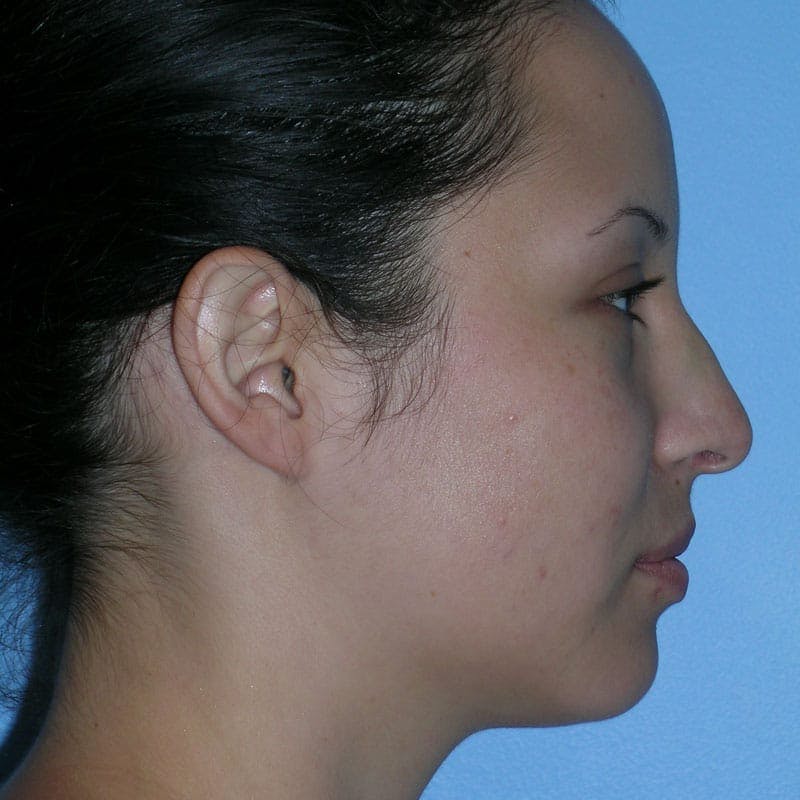 Small Changes Before & After Gallery - Patient 958037 - Image 5