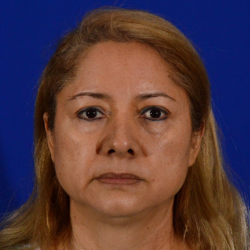 Revision Rhinoplasty Before & After Gallery - Patient 197355 - Image 5