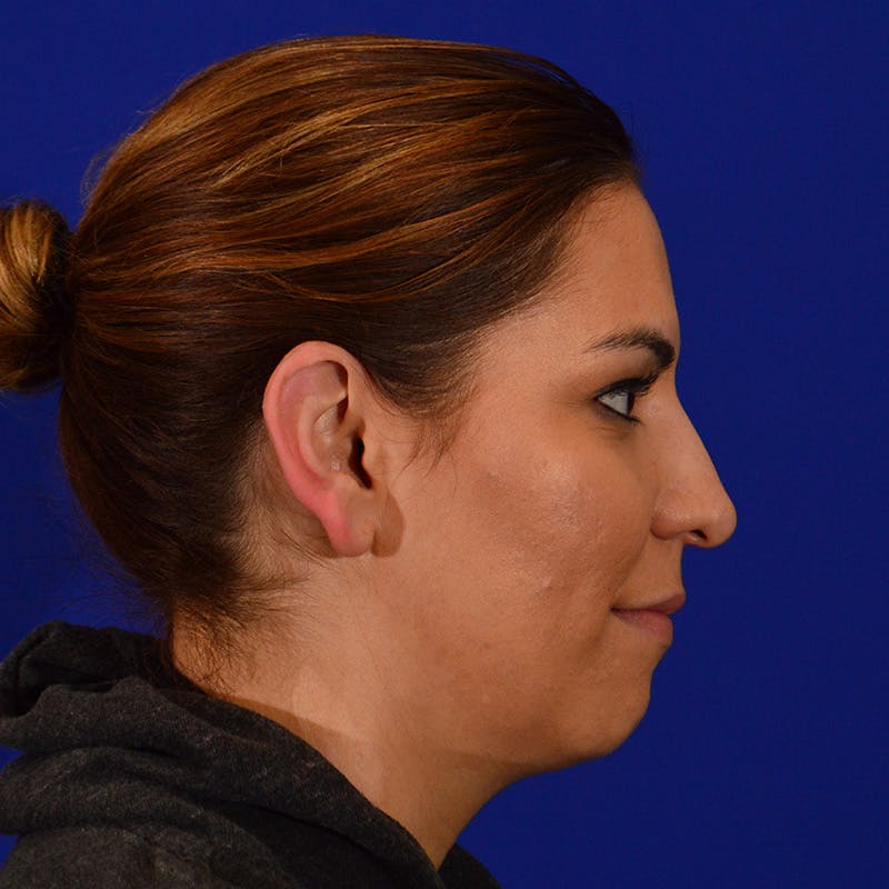 Chin Augmentation Before & After Gallery - Patient 287872 - Image 5