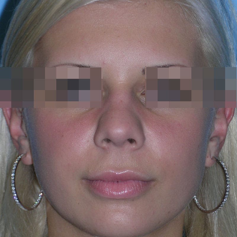 Wide Nose Before & After Gallery - Patient 927911 - Image 1