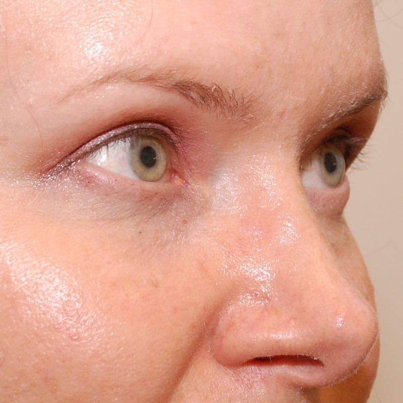 Upper Eyelid Surgery Before & After Gallery - Patient 231404 - Image 6