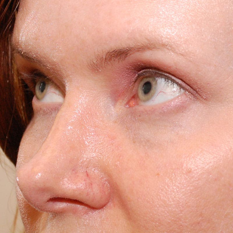 Upper Eyelid Surgery Before & After Gallery - Patient 231404 - Image 4