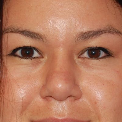 Upper Eyelid Surgery Before & After Gallery - Patient 378728 - Image 1