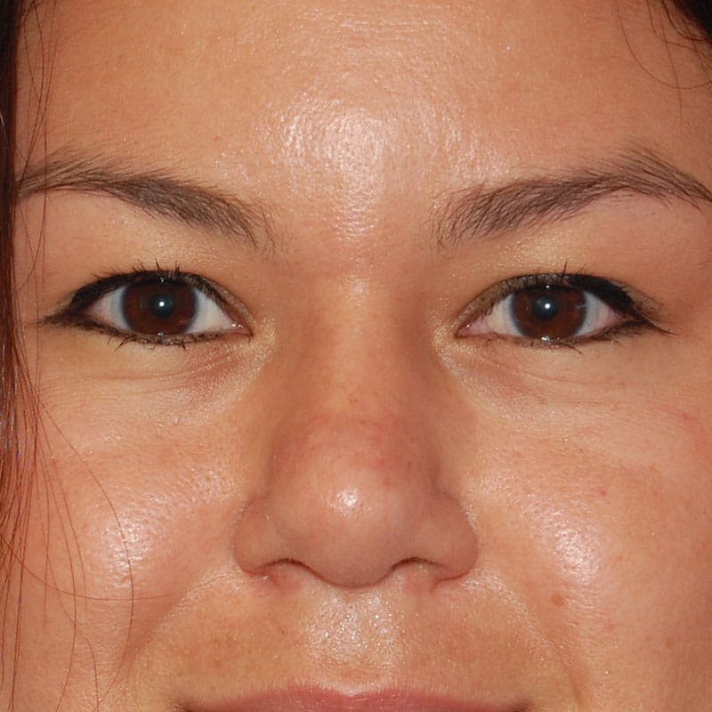 Upper Eyelid Surgery Before & After Gallery - Patient 378728 - Image 1