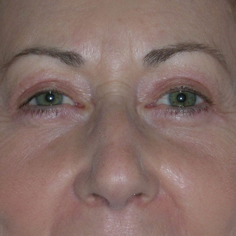 Upper Eyelid Surgery Before & After Gallery - Patient 190045 - Image 2