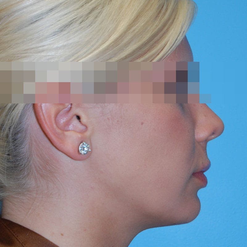 Wide Nose Before & After Gallery - Patient 927911 - Image 6