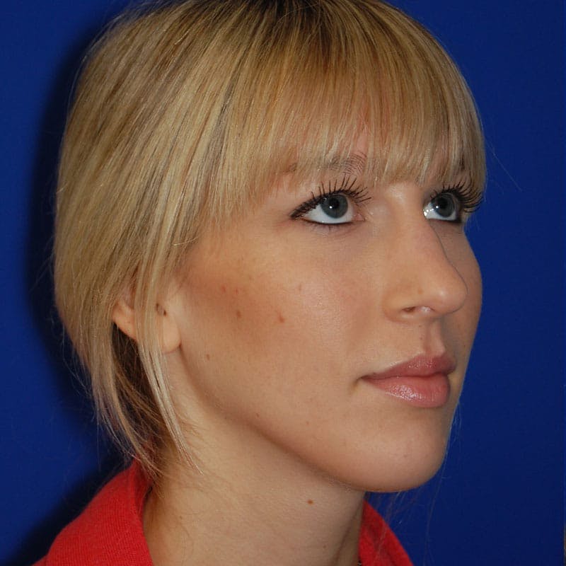 Wide Nose Before & After Gallery - Patient 428128 - Image 3