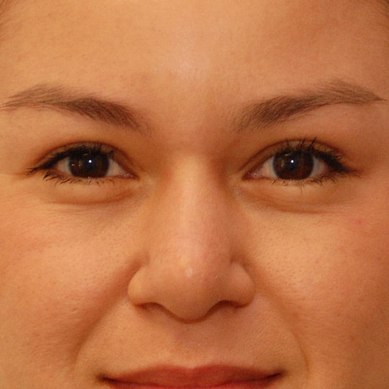Upper Eyelid Surgery Before & After Gallery - Patient 378728 - Image 2