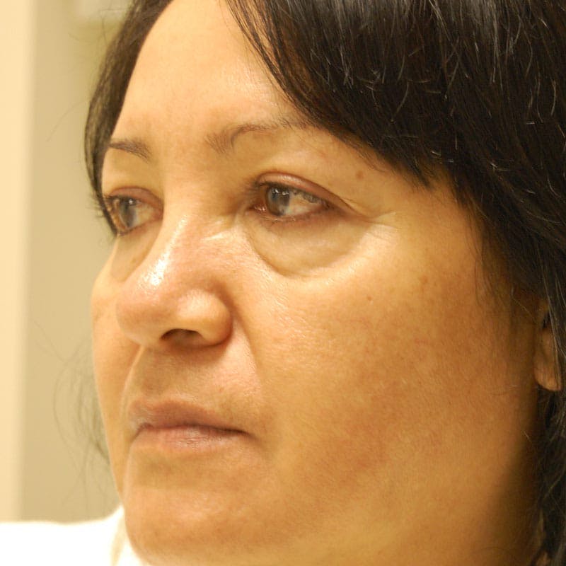 Upper Eyelid Surgery Before & After Gallery - Patient 363334 - Image 3