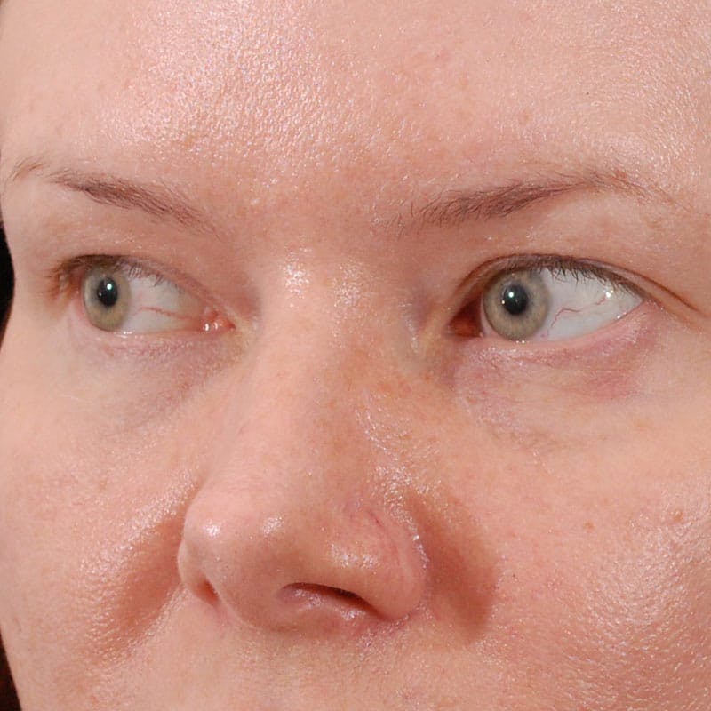 Upper Eyelid Surgery Before & After Gallery - Patient 231404 - Image 3