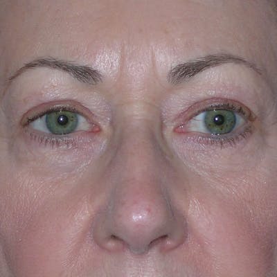 Upper Eyelid Surgery Before & After Gallery - Patient 190045 - Image 1