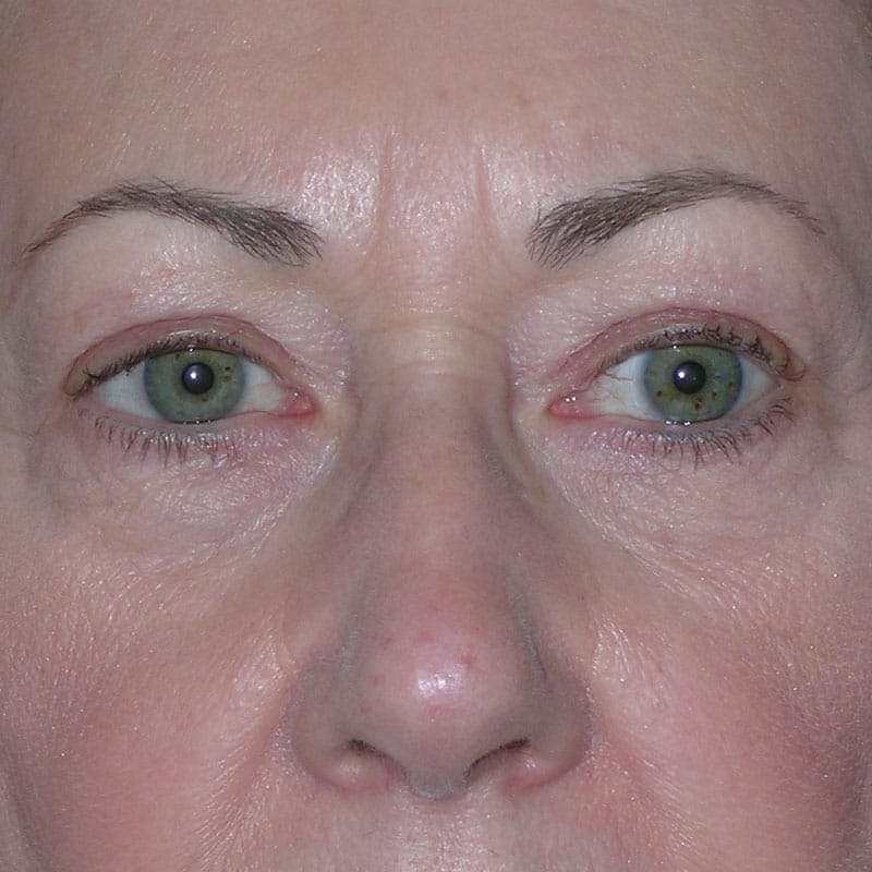 Upper Eyelid Surgery Before & After Gallery - Patient 190045 - Image 1