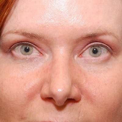 Upper Eyelid Surgery Before & After Gallery - Patient 231404 - Image 2