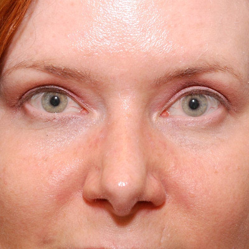 Upper Eyelid Surgery Before & After Gallery - Patient 231404 - Image 2
