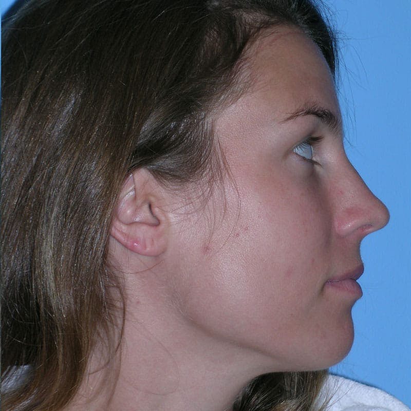 Wide Nose Before & After Gallery - Patient 778796 - Image 5