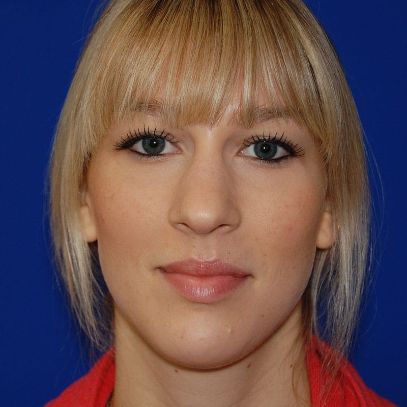 Wide Nose Before & After Gallery - Patient 428128 - Image 1