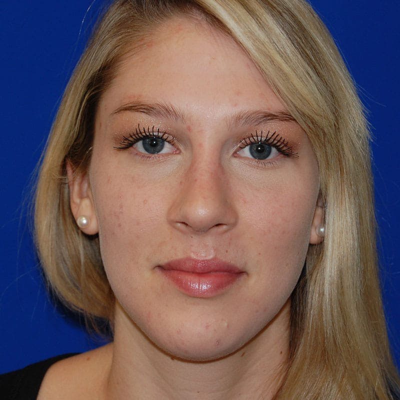 Wide Nose Before & After Gallery - Patient 428128 - Image 2