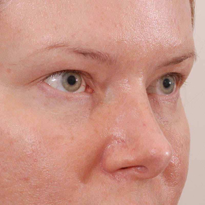 Upper Eyelid Surgery Before & After Gallery - Patient 231404 - Image 5