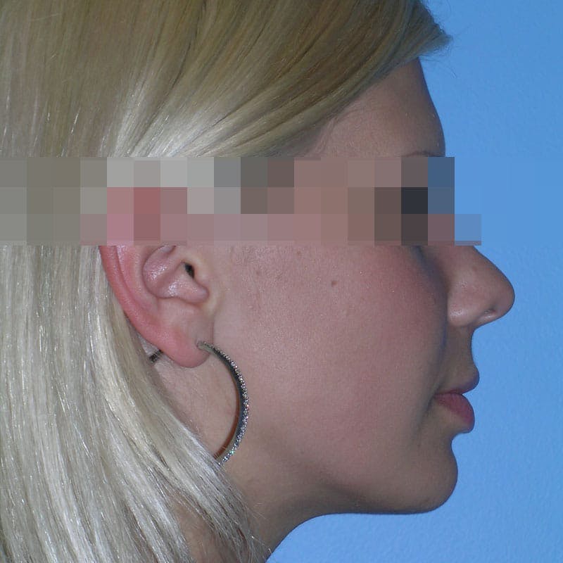 Wide Nose Before & After Gallery - Patient 927911 - Image 5
