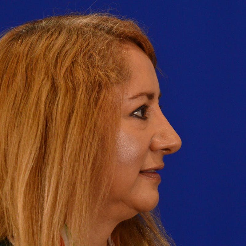 Revision Rhinoplasty Before & After Gallery - Patient 197355 - Image 2