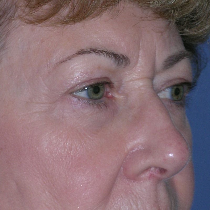 Upper Eyelid Surgery Before & After Gallery - Patient 190045 - Image 3