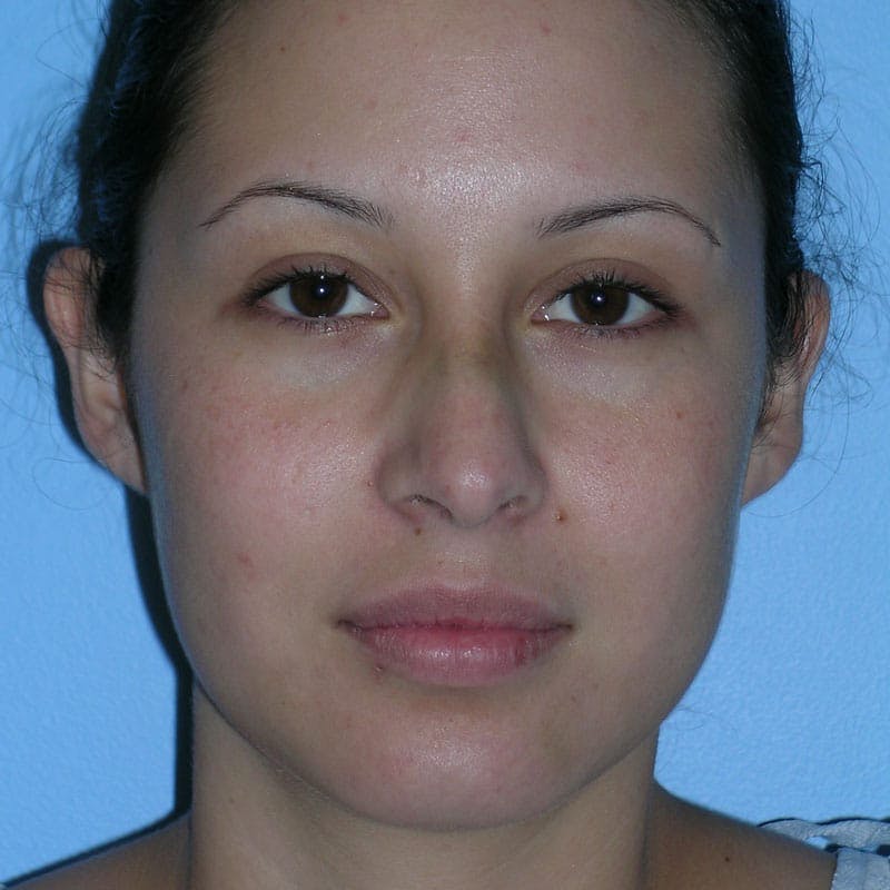 Small Changes Before & After Gallery - Patient 958037 - Image 1