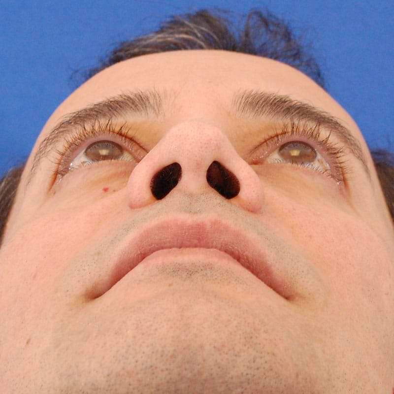 Revision Rhinoplasty Before & After Gallery - Patient 617931 - Image 8