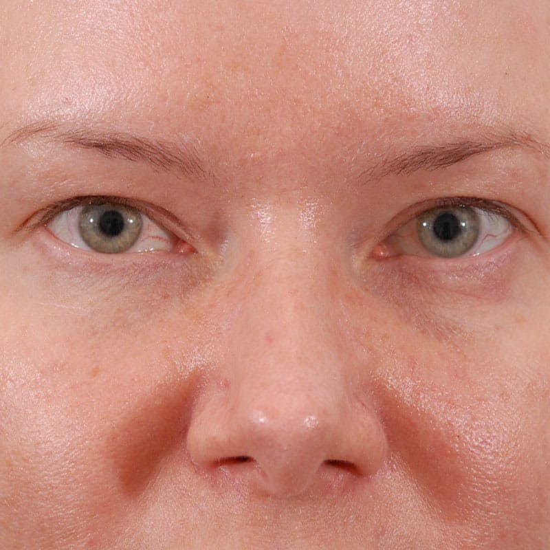 Upper Eyelid Surgery Before & After Gallery - Patient 231404 - Image 1