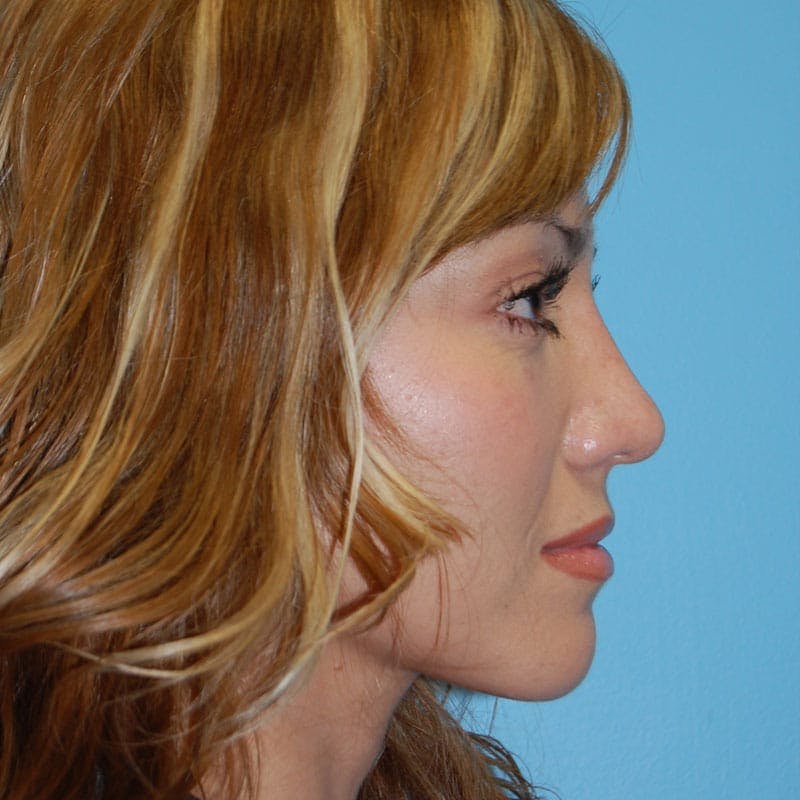Small Changes Before & After Gallery - Patient 138630 - Image 6