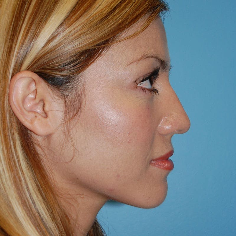 Small Changes Before & After Gallery - Patient 138630 - Image 5