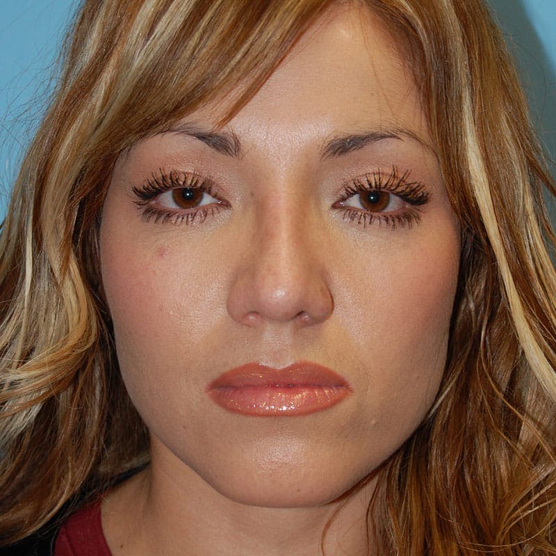 Small Changes Before & After Gallery - Patient 138630 - Image 2