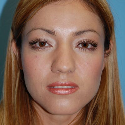 Small Changes Before & After Gallery - Patient 138630 - Image 1