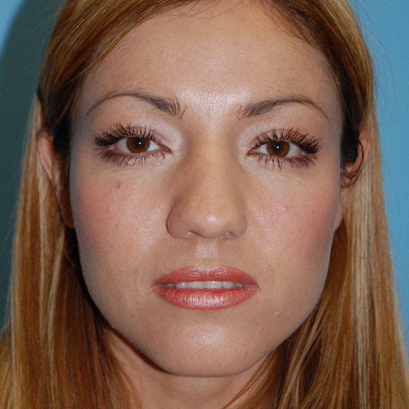 Small Changes Before & After Gallery - Patient 138630 - Image 1