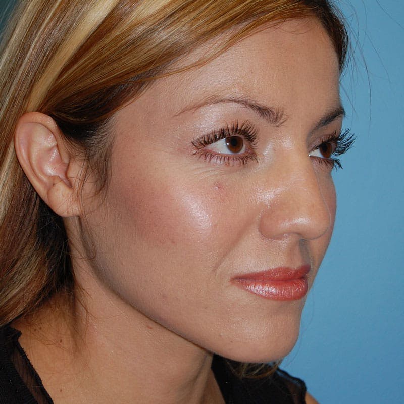 Small Changes Before & After Gallery - Patient 138630 - Image 3
