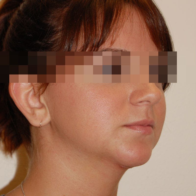Chin Augmentation Before & After Gallery - Patient 356661 - Image 4