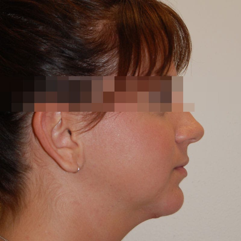 Chin Augmentation Before & After Gallery - Patient 356661 - Image 6