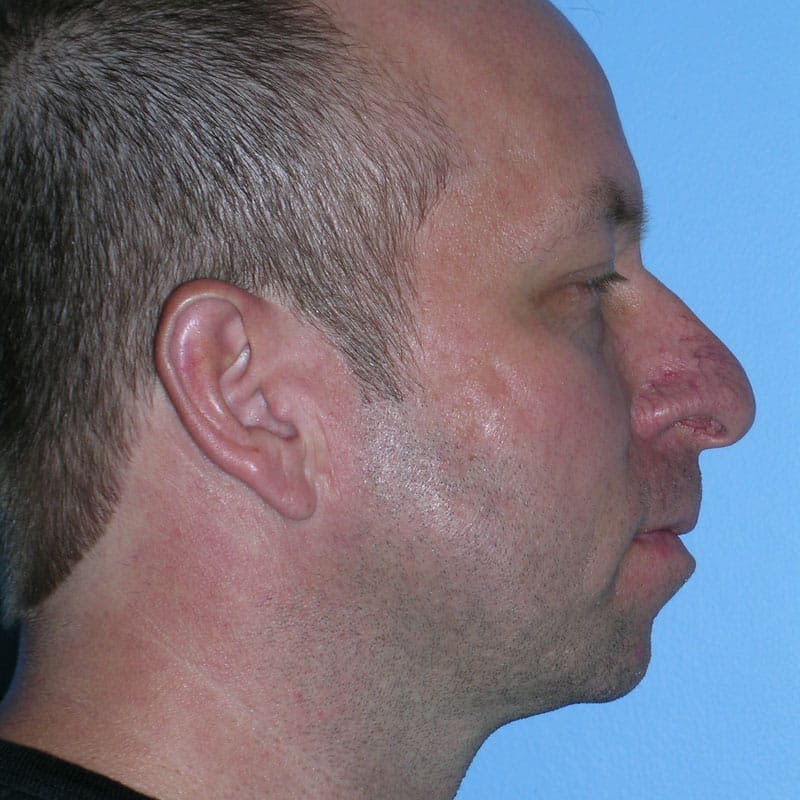 Chin Augmentation Before & After Gallery - Patient 145323 - Image 5