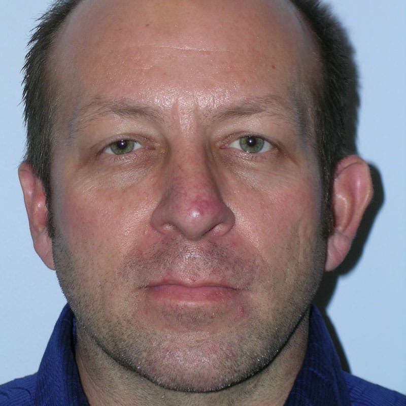 Chin Augmentation Before & After Gallery - Patient 145323 - Image 2