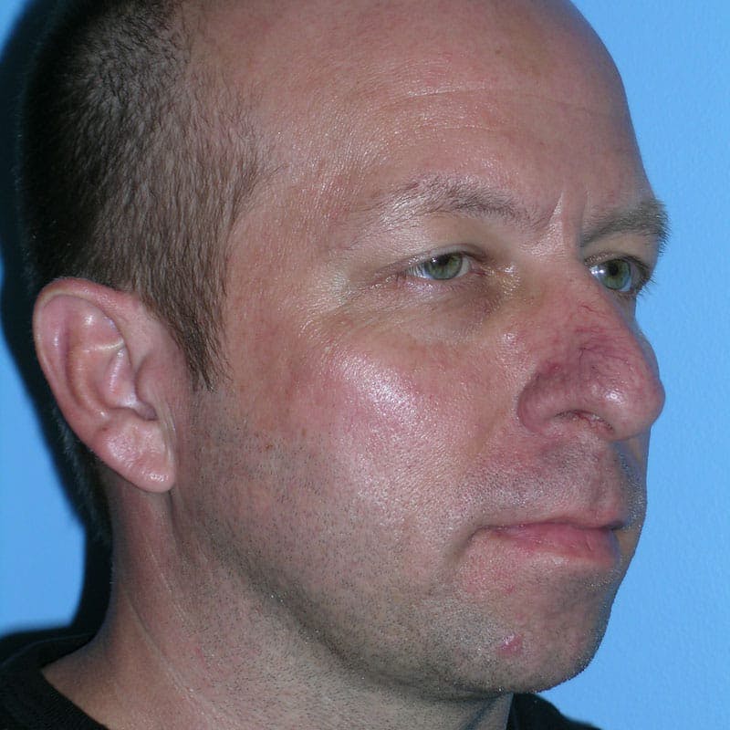 Chin Augmentation Before & After Gallery - Patient 145323 - Image 3