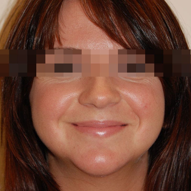 Chin Augmentation Before & After Gallery - Patient 356661 - Image 2