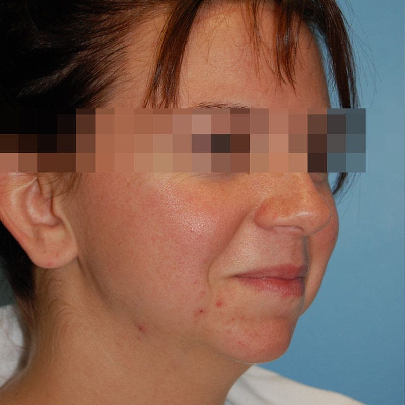 Chin Augmentation Before & After Gallery - Patient 356661 - Image 3