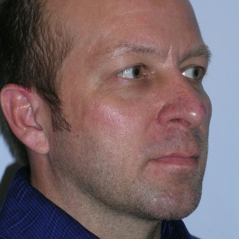 Chin Augmentation Before & After Gallery - Patient 145323 - Image 4