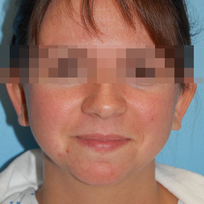 Chin Augmentation Before & After Gallery - Patient 356661 - Image 1