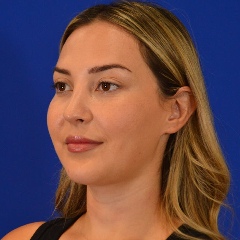 Submental Liposuction Before & After Gallery - Patient 102977 - Image 8