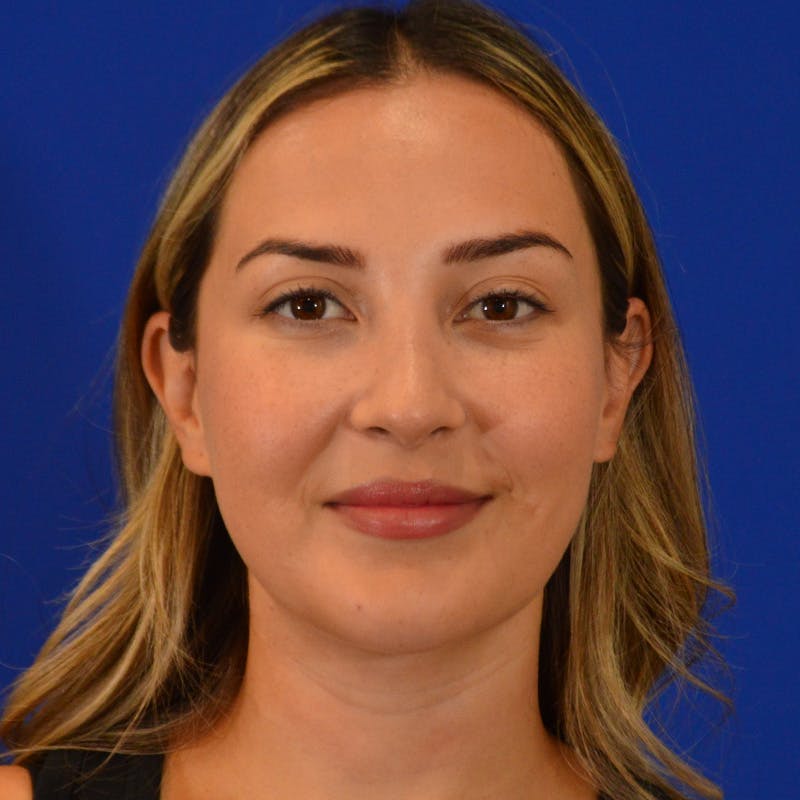 Submental Liposuction Before & After Gallery - Patient 102977 - Image 6