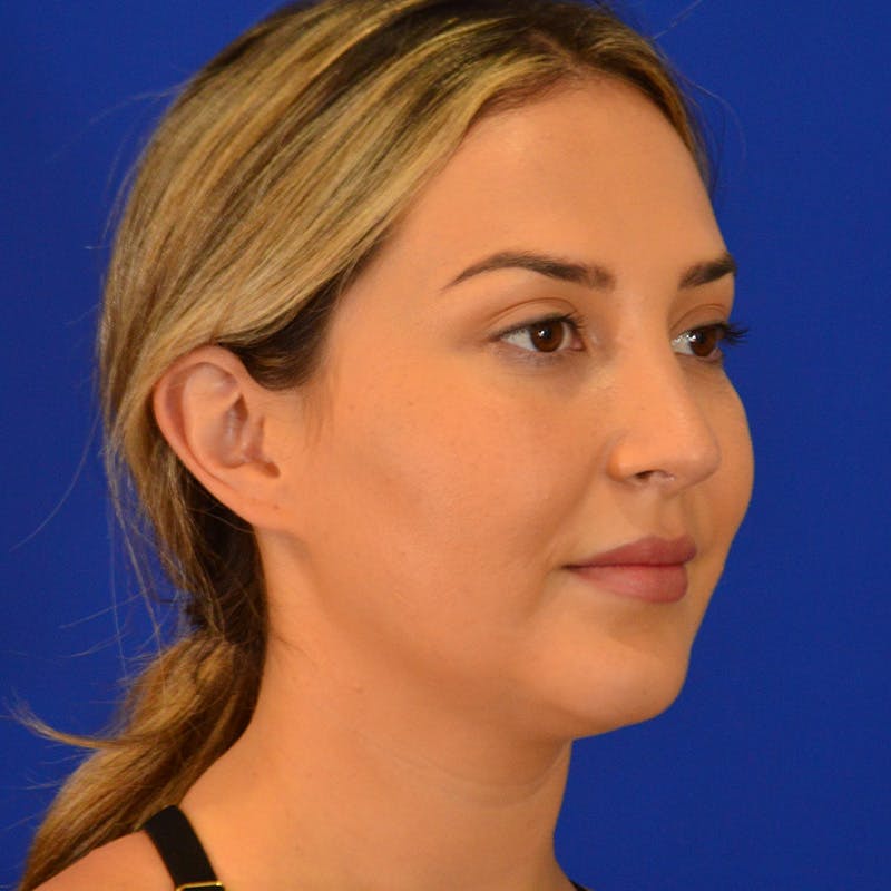 Submental Liposuction Before & After Gallery - Patient 102977 - Image 3