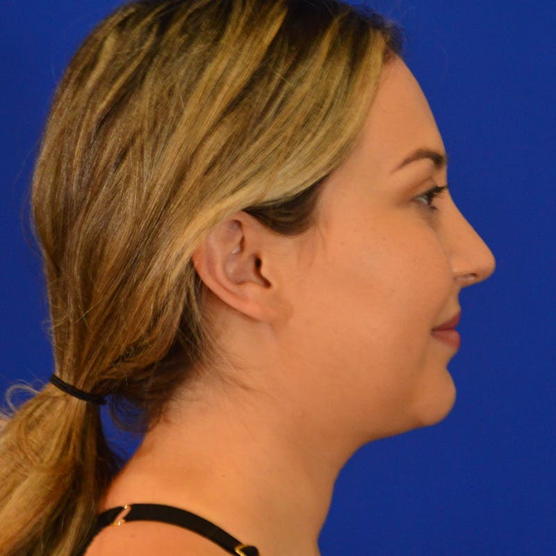 Submental Liposuction Before & After Gallery - Patient 102977 - Image 1