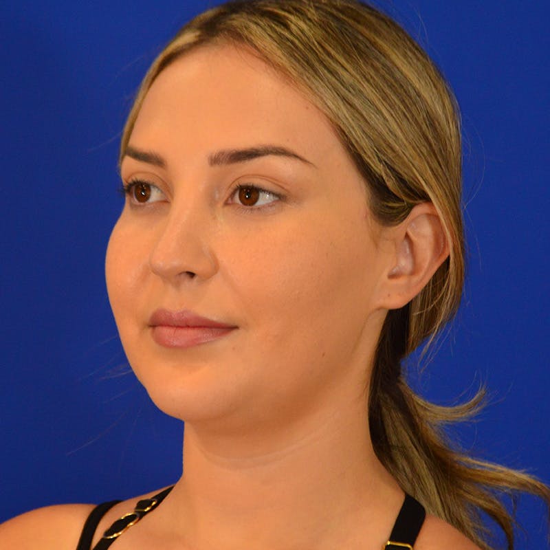 Submental Liposuction Before & After Gallery - Patient 102977 - Image 7